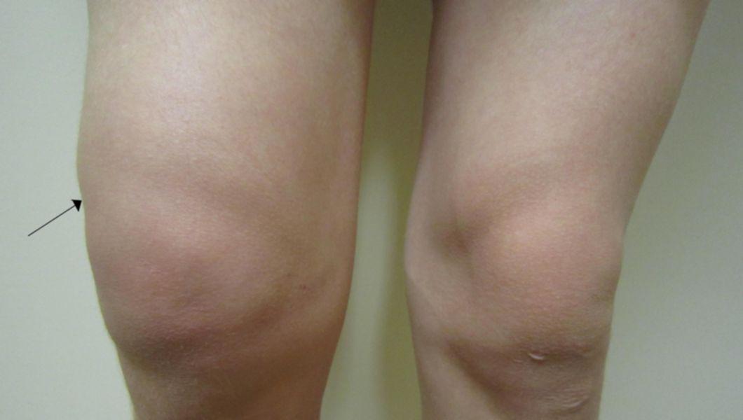 Apă la genunchi - simptome și tratament