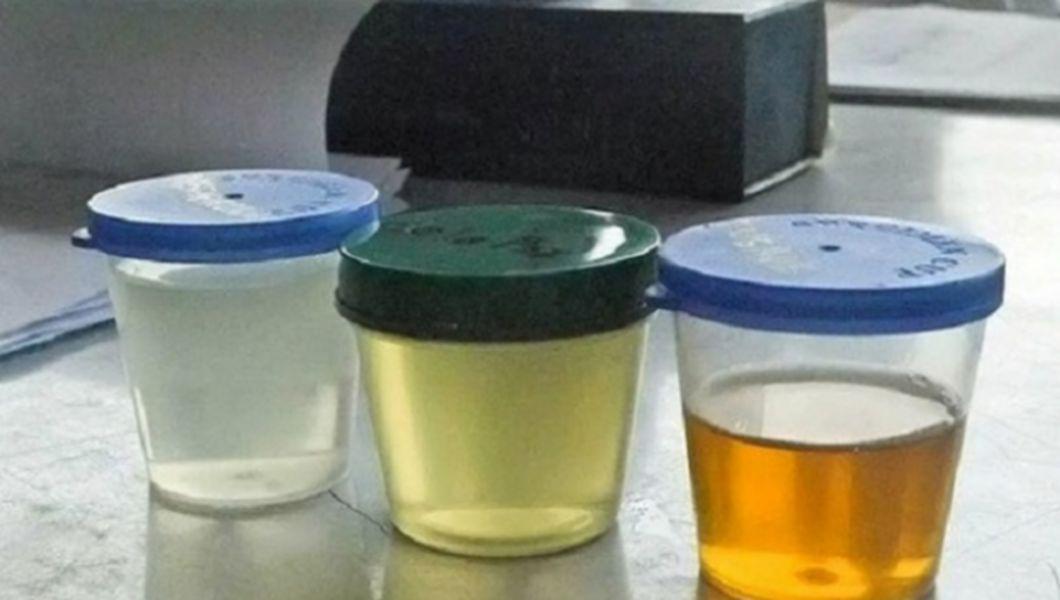 Culoarea Urinei Ofera Indicii Despre Starea De Sanatate Bzi Ro