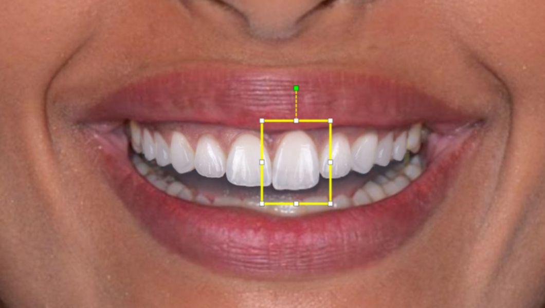Fatetele Dentare Cum Sa Le Alegi Pentru A Avea Un Zambet Perfect Buna Ziua Iasi Bzi Ro