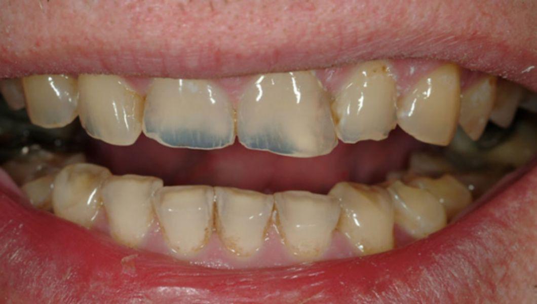 Cum Apare Si Cum Prevenim Eroziunea Dentara Buna Ziua Iasi Bzi Ro