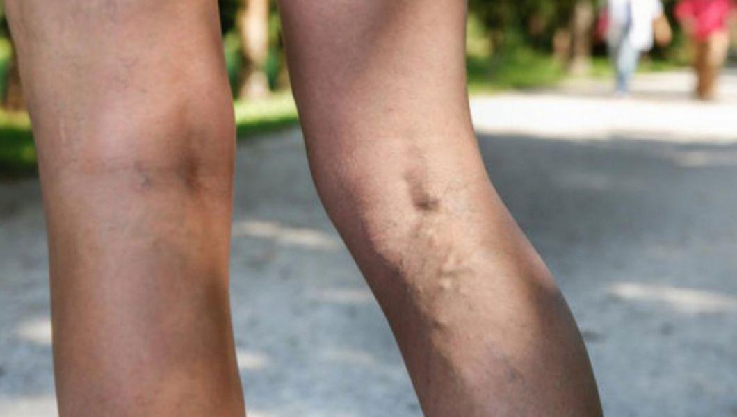 prevenirea venelor vene pe picioarele dietei vene sparte pe picioare crema