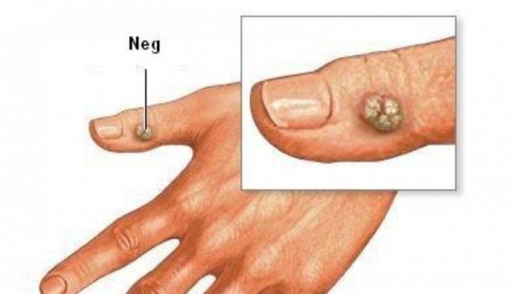 scapa de negi rapid papillomavirus infection peau