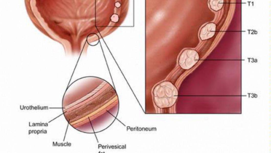 cancer vezica urinara stadiul 3 cati ani apare prostatita?
