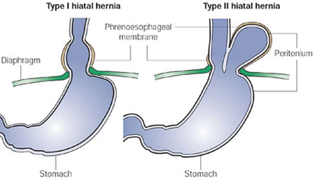 Hernia Hiatala Buna Ziua Iasi Bzi Ro