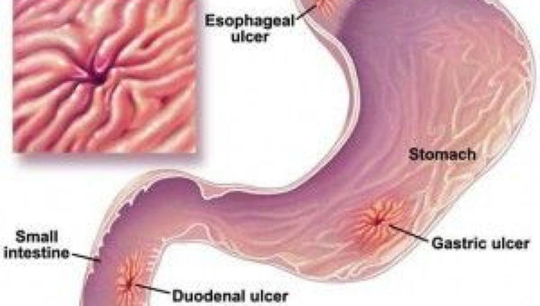 Trateaza Ulcerul Duodenal Si Ulcerul Gastric Cu Comprimatele