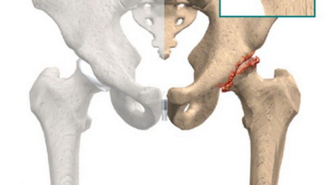 3 factori de risc pentru dureri osteoarticulare | experttraining.ro