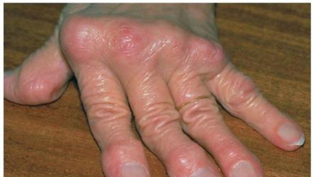 tratament pentru guta la maini