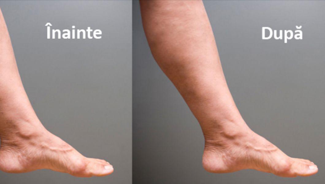 reete populare pentru picioarele varicoase