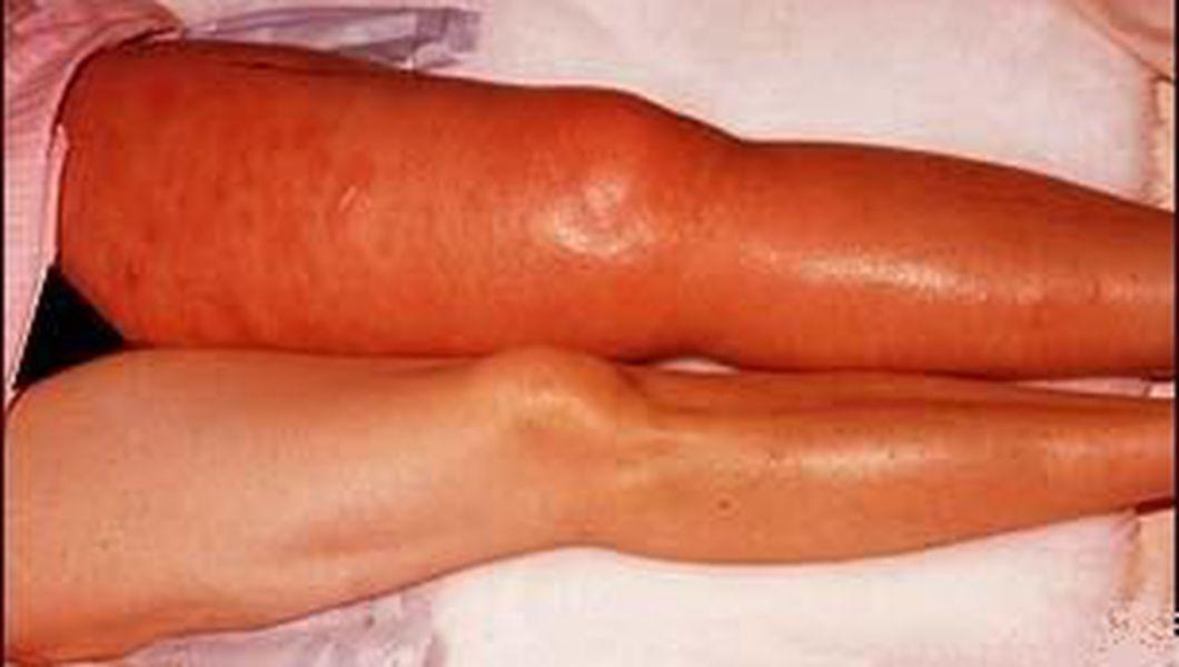 tromboflebita la picior tratament naturist complexe de exerciii în varicoza