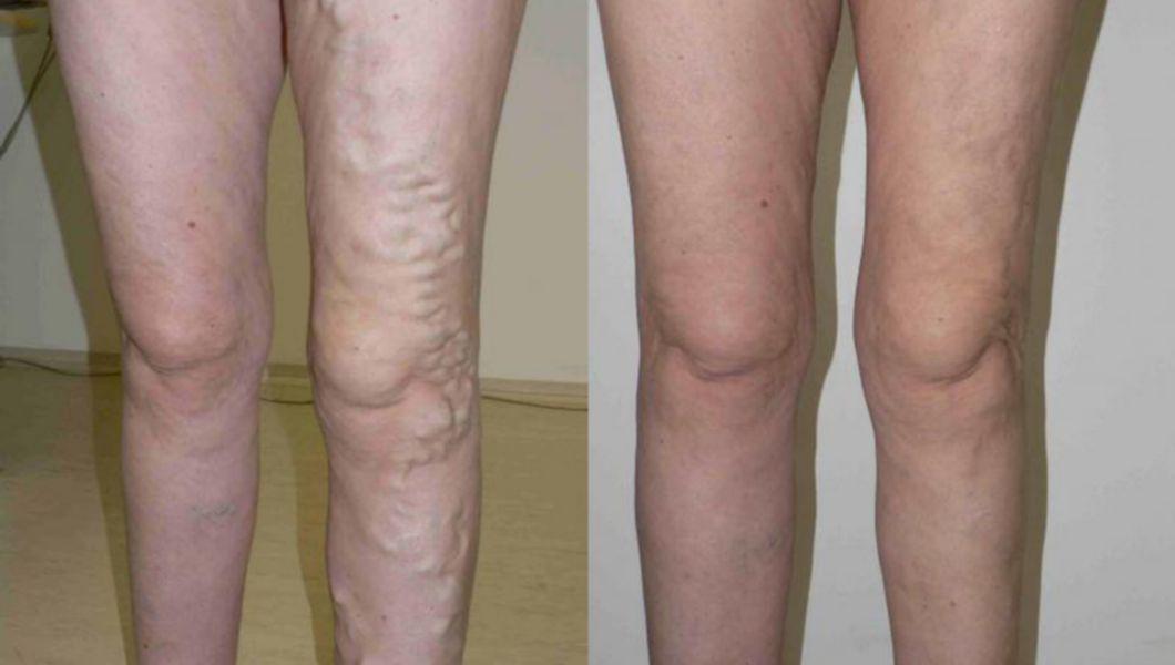 Simptome ale varicelor (varice) pe picioare - Anevrismul 