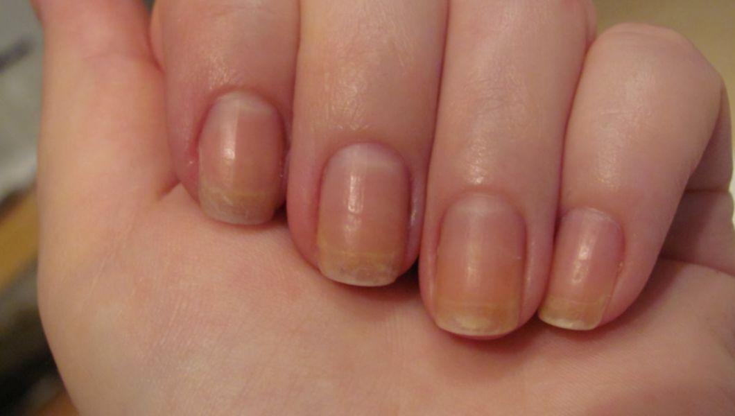Cât durează un hematom subungual pe degetul mare și cum să-l tratezi