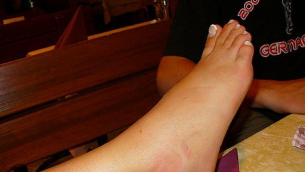 Remediu pentru edemul picioarelor cu vene varicoase - Cauze de înroșire pe picior