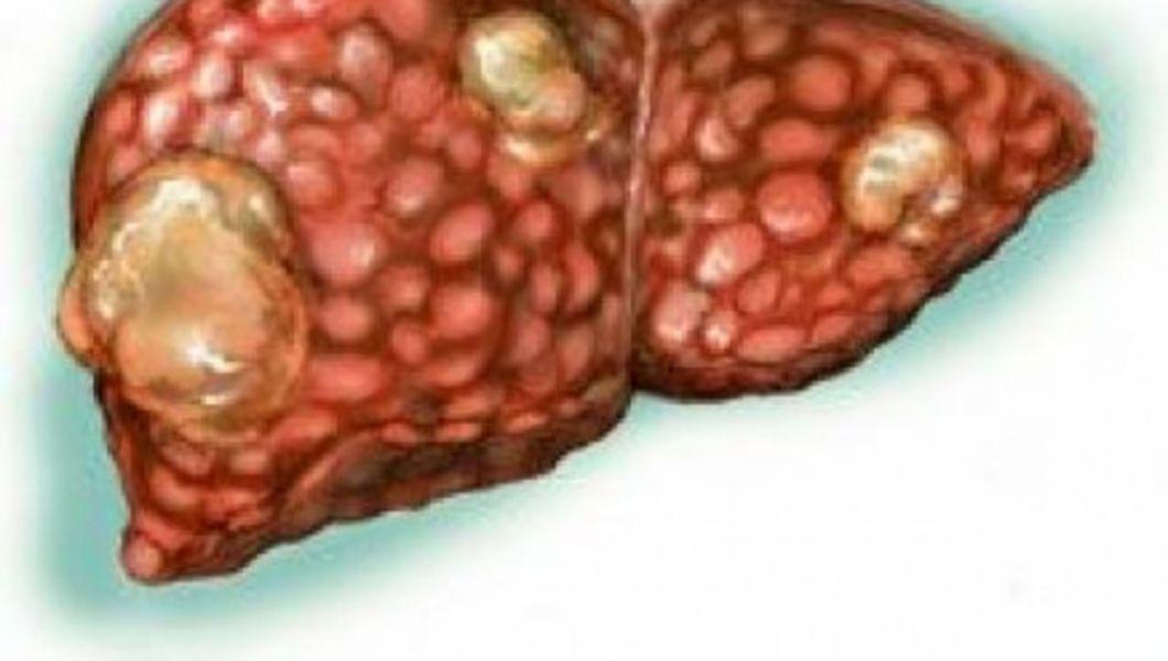 Steatoza Hepatica Remedii Din Plante Buna Ziua Iasi Bzi Ro