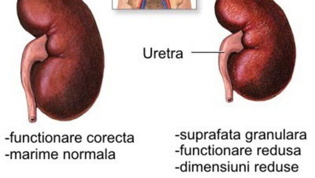 Simptome ale rinichilor bolnavi. La ce trebuie sa fii foarte atent