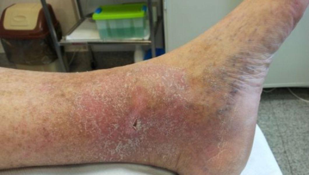 insuficienta venoasa la picioare tratament ca este posibil ca sa fie imposibil în varicoza