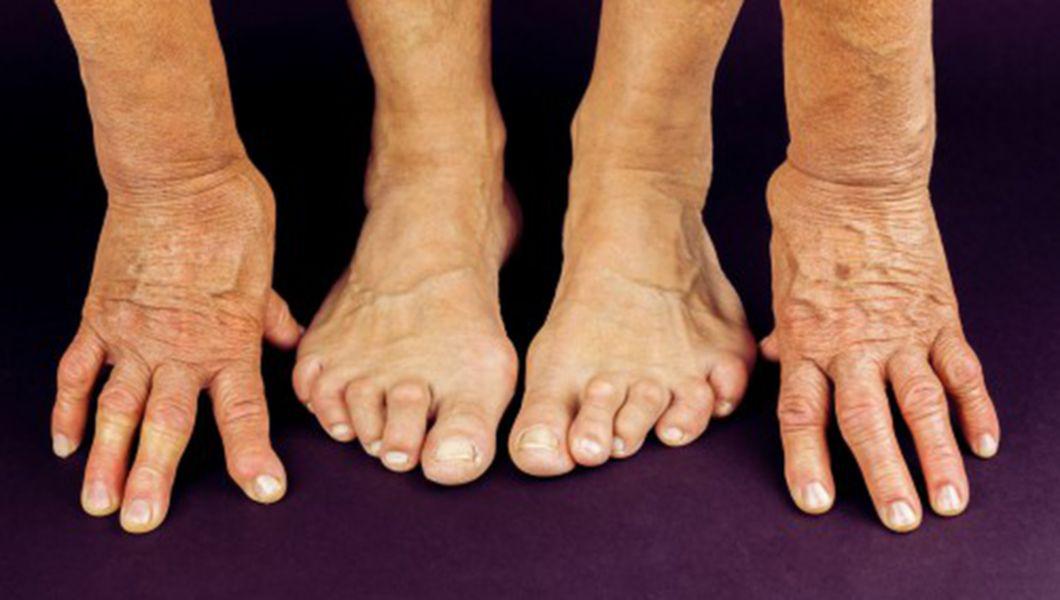 deformarea artritei cum se tratează tratăm vasele articulației genunchiului