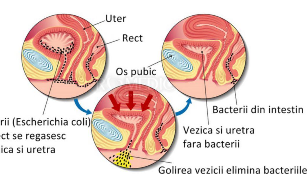 cum scapi de infectia urinara prostatitis aguda bacteriana