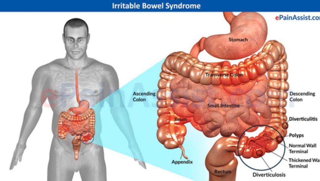 Cum deosebim sindromul intestinului iritabil de cancerul de colon