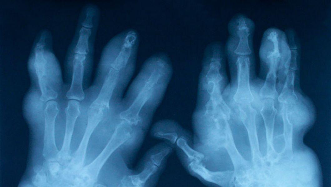 care este diferența dintre artroza și artrita mâinilor)