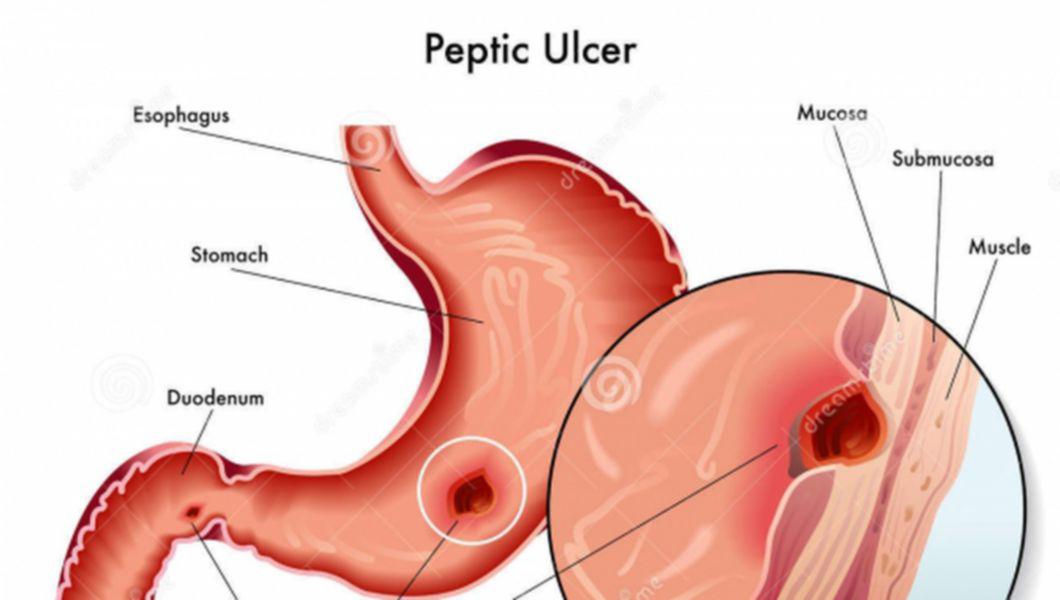 Tratament Medicamentos Pentru Ulcerul Gastric Sindromul Colonului Iritabil Si Infectiile Intestinale Buna Ziua Iasi Bzi Ro