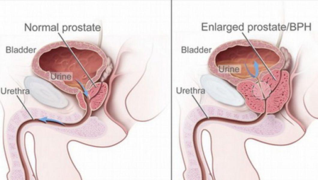 tratament hiperplazie benigna de prostata)