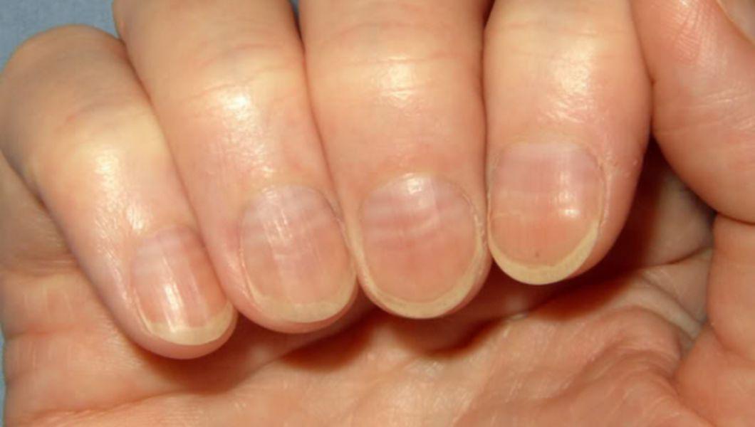 ciuperca unghiilor si pielii medicina traditionala