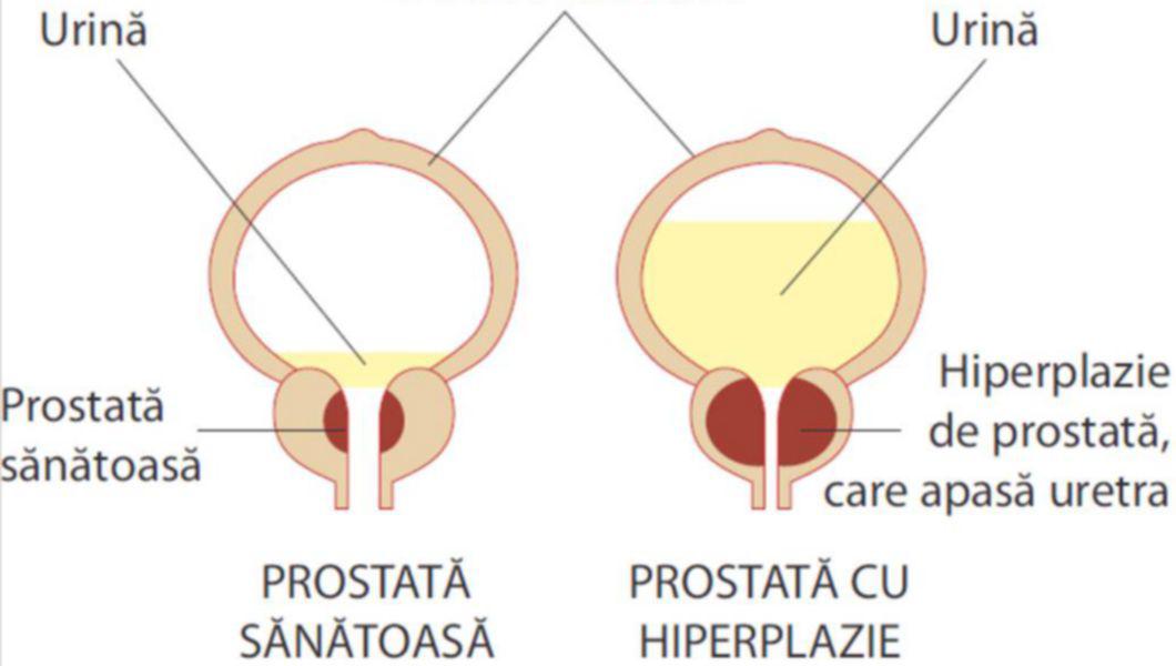 uretrita si prostatita la barbati prostata sintomi della malattia