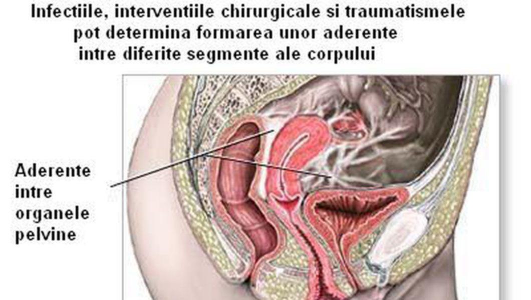 Boala Inflamatorie Pelvina Buna Ziua Iasi Bzi Ro