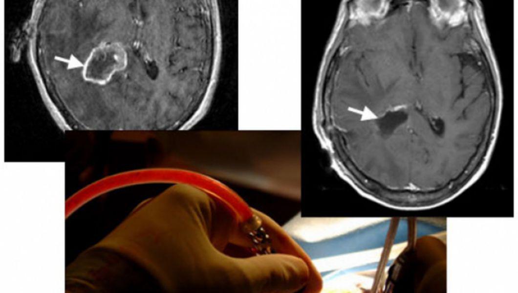 10 Cauze Ale Leziunilor Cerebrale Bzi Ro