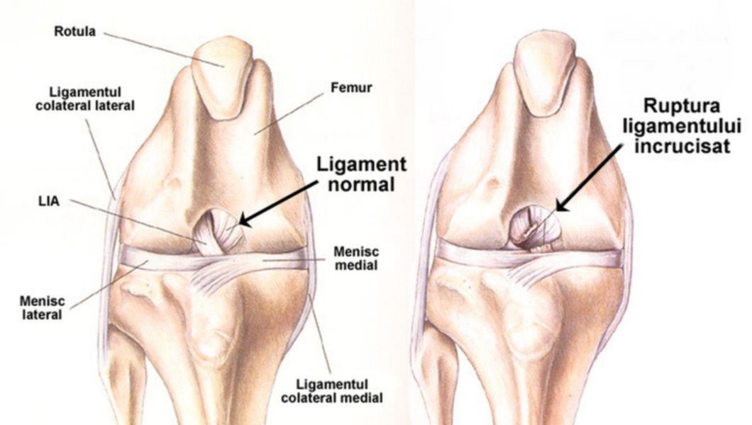 Cum se tratează ligamentele genunchiului