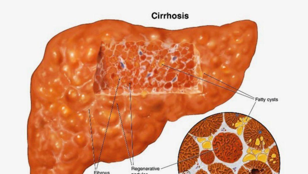 Cum Recunoastem Ciroza Hepatica Boala Care A Ucis O Pe Ileana Ciuculete Buna Ziua Iasi Bzi Ro