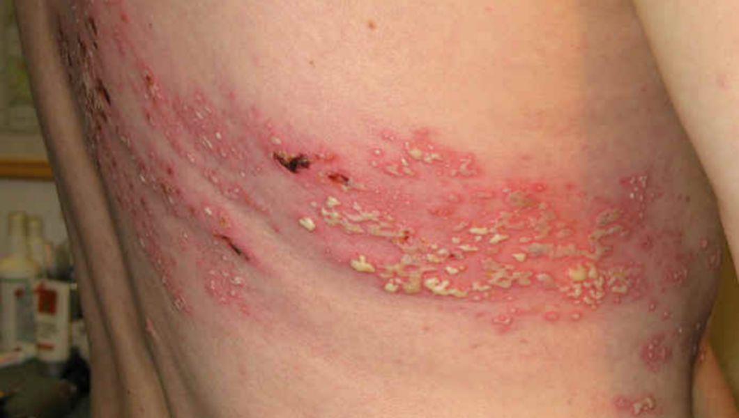 Famvir Comprimate Indicat In Tratamentul Formei Acute A Infectiei Cu Herpes Zoster Bzi Ro