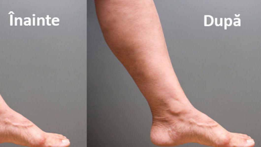 Cum de a elimina picioarele de umflare în varicoza, Gimnastică cu umflarea picioarelor și varice