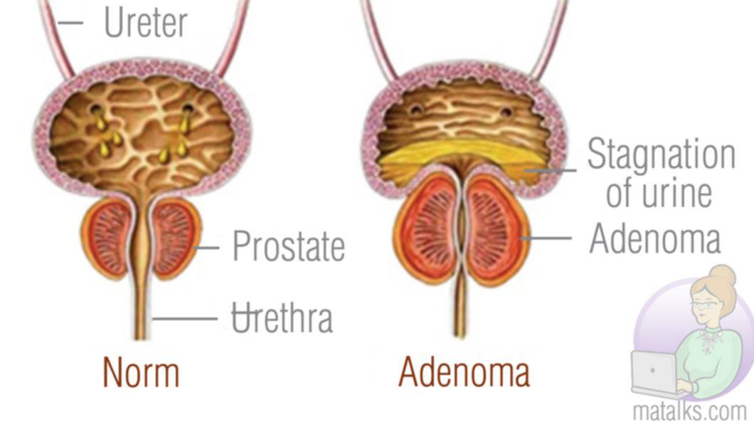 adenom de prostată la 20 de ani prostate cancer stages 1 10