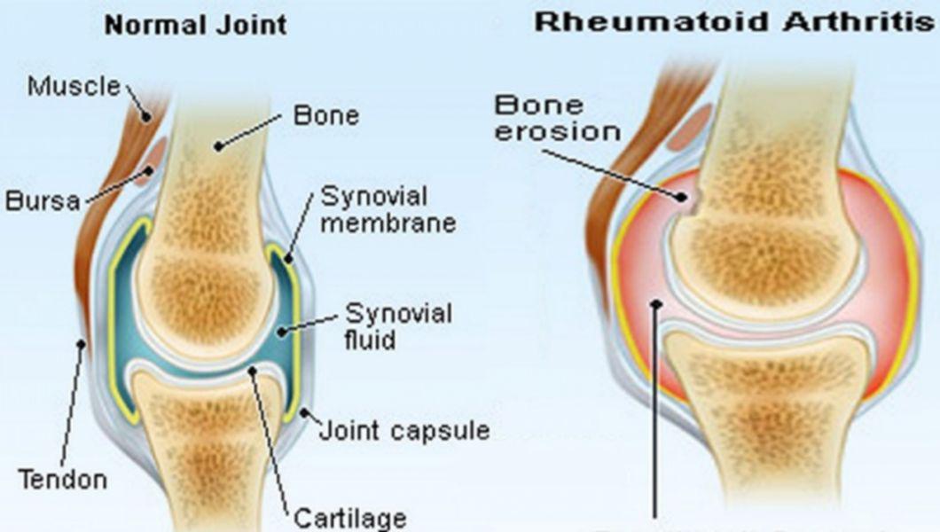 Artroza și tratamentul acesteia cu miere. Reumatism: Ce este, Care sunt Simptomele & Tratament