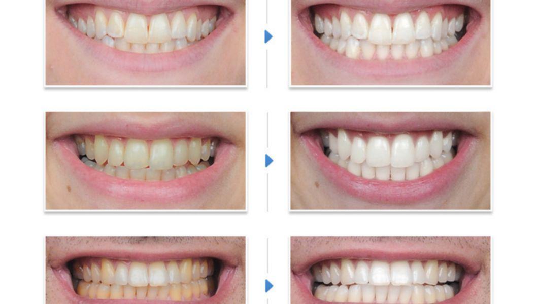Лазерное отбеливание отзывы. Отбеливание зубов. Этапы отбеливания зубов. Стоматология отбеливание.