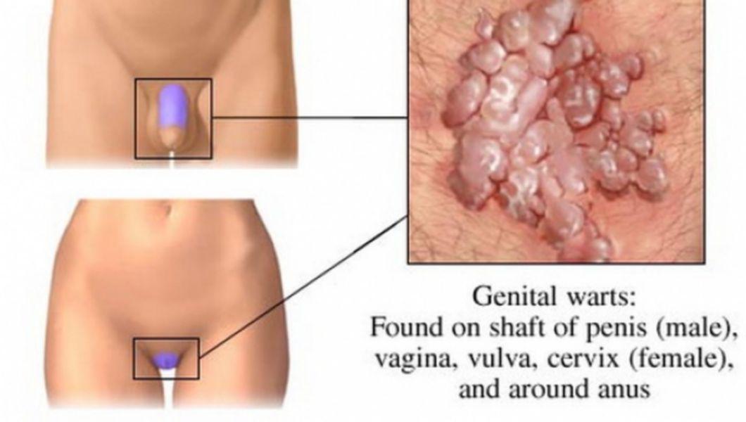 condiloame vaginal