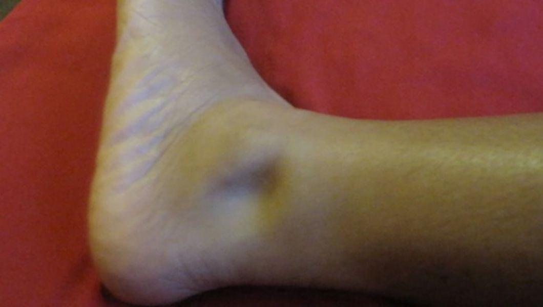 edemul unui picior varicoză exerciții de la vene varicoase ale unui mic pelvis