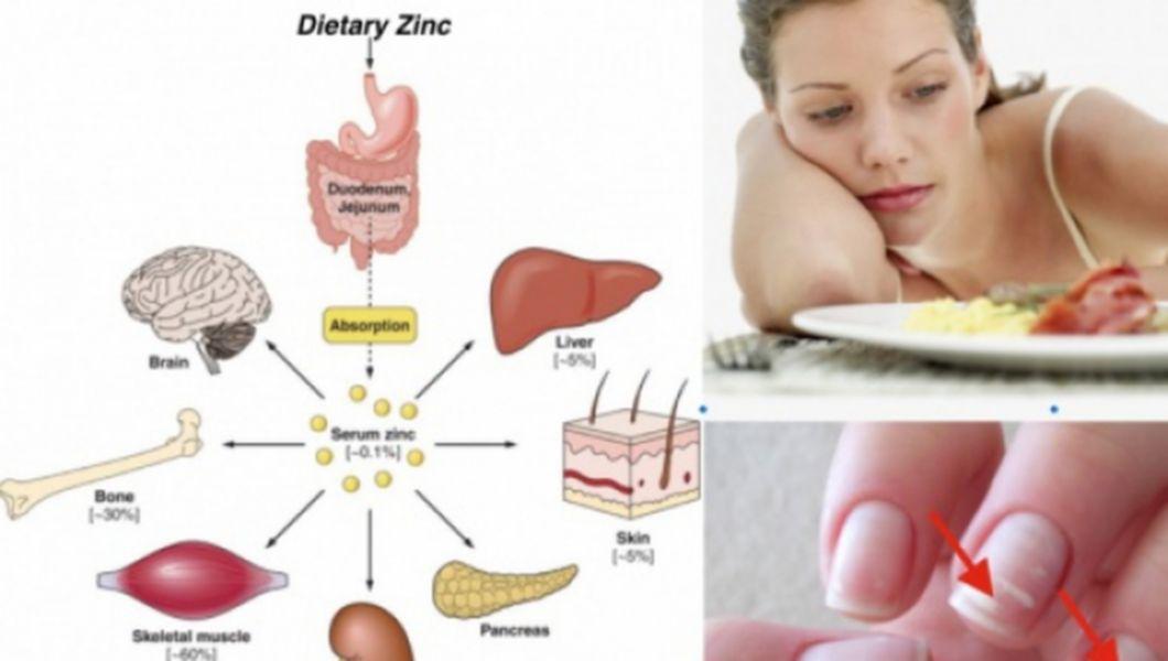Deficienta sau lipsa de zinc: simptome, diagnostic, tratament