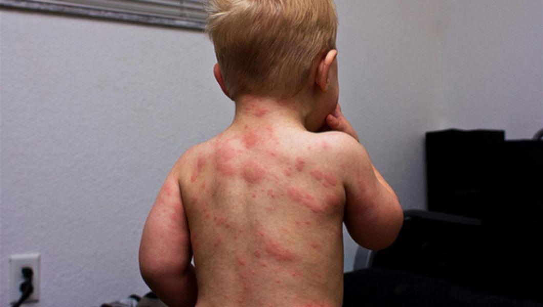 Roseola Infantum A Sasea Boala A Copilariei Simptome Cauze Si Tratament Buna Ziua Iasi Bzi Ro