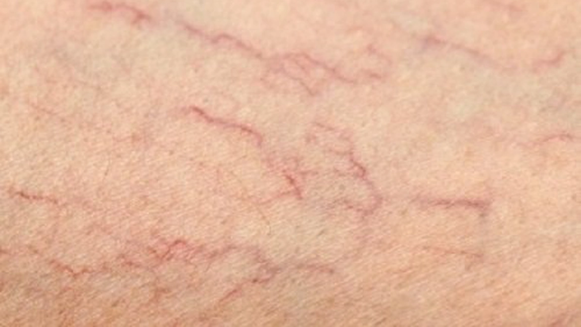 Venele in panza de paianjen: 5 remedii