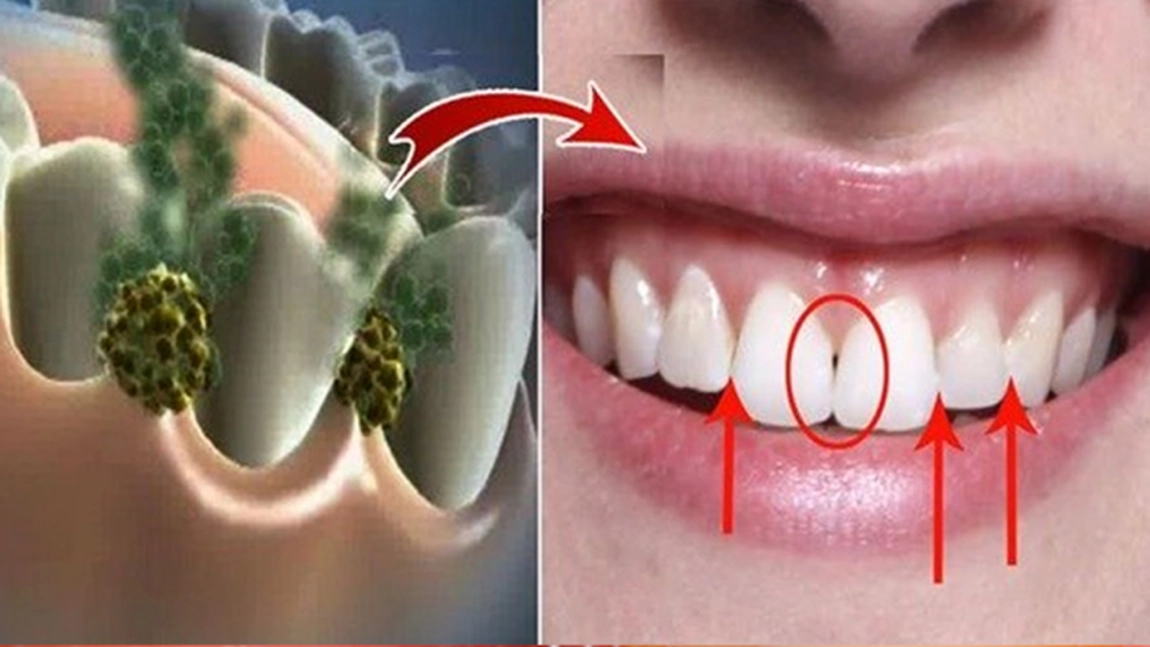 Ce trebuie sa faci ca sa nu-ti mai miroasa gura urat! Leacul care omoara toate bacteriile din gura ta in doar 5 minute si care parfumeaza respiratia