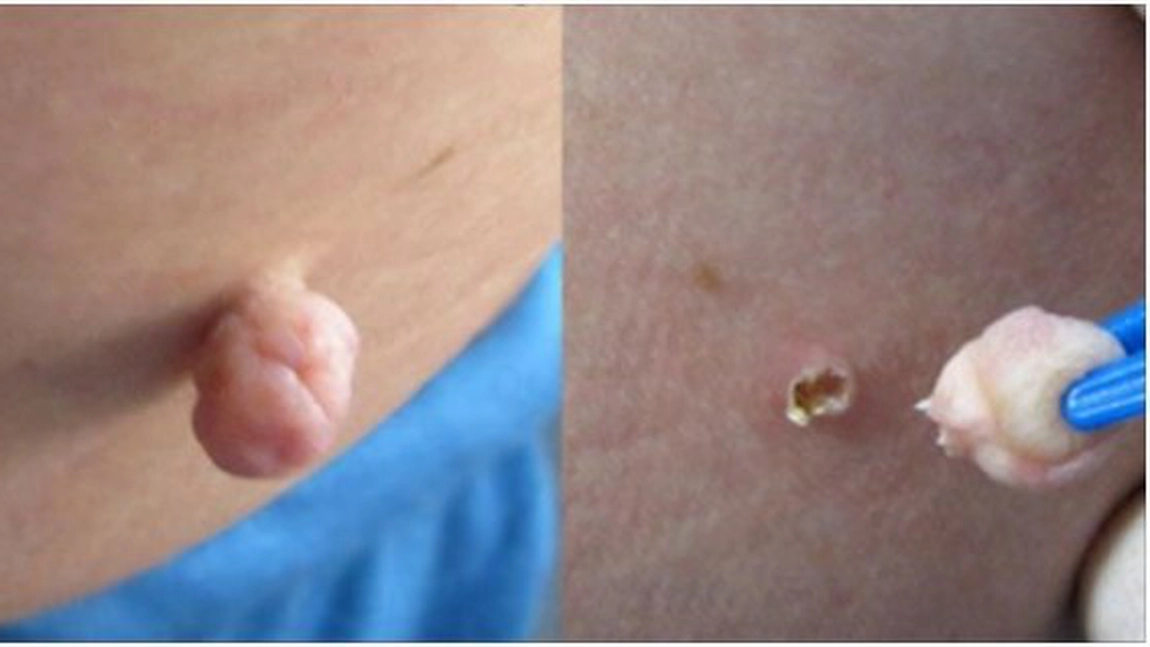 Remediul natural si ieftin care face negii sa se desprinda de pe piele, pur si simplu, fara interventie chirurgicala!