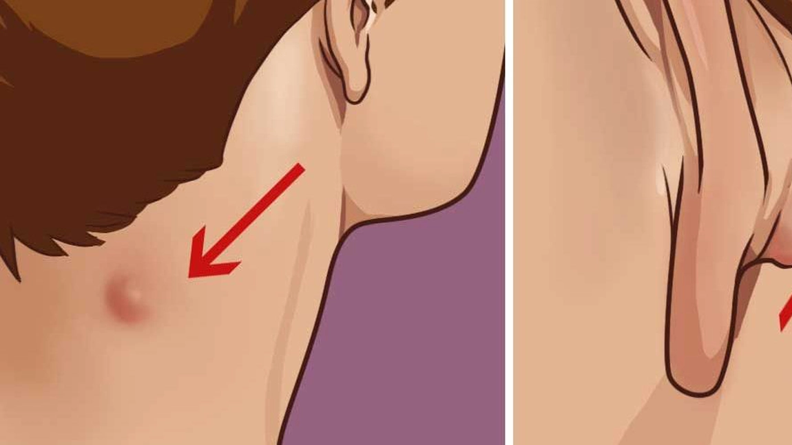 Ai astfel de noduli pe gat, spate sau la ureche? Iata tot ce trebuie sa stii si cum poti scapa de ei in mod natural