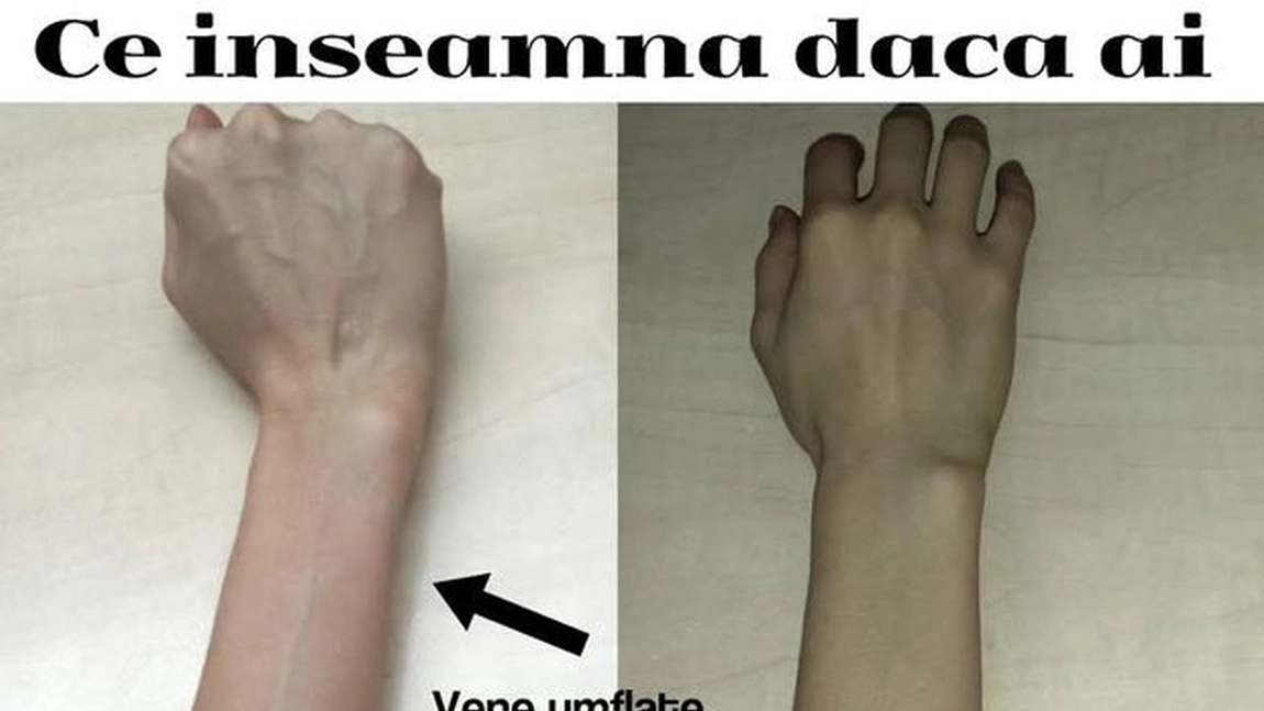 Ce se intampla daca ai venele umflate. Cand ar trebui sa te ingrijorezi