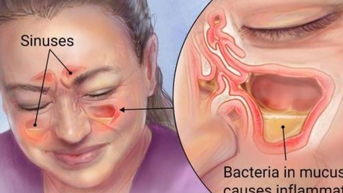 Ceaiul care te scapa de streptococul in gat, gripa si infectiile sinusurilor – vezi cum se prepara