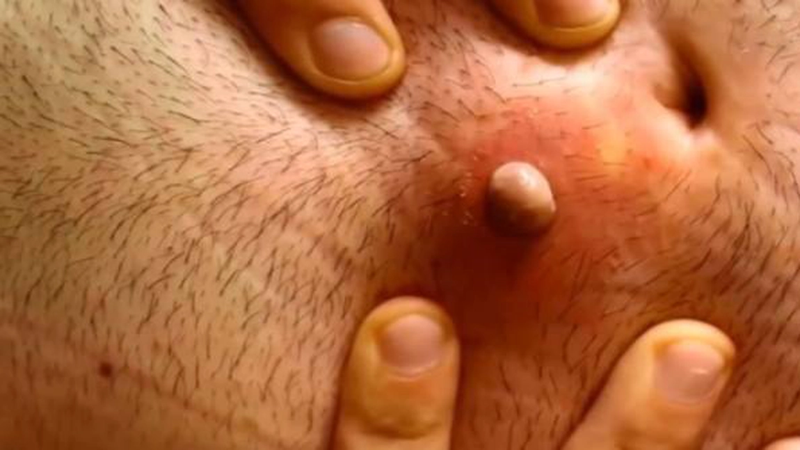 Si-a ras parul de pe abdomen, dar, dupa trei luni, a observat umflatura asta langa buric. Dupa inca un an, cand iubita lui, asistenta medicala, a vrut sa o sparga, s-a speriat de ce a vazut 