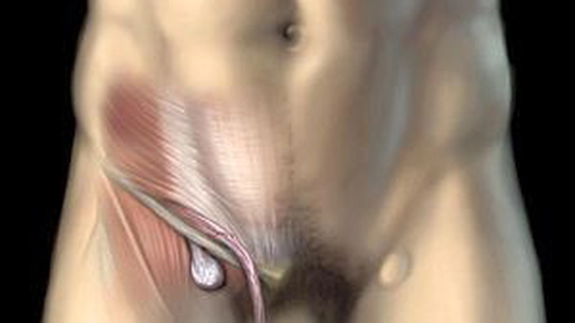 Hernia femurala - pe locul doi ca frecventa dintre hernii, informatii medicale, chirurgie