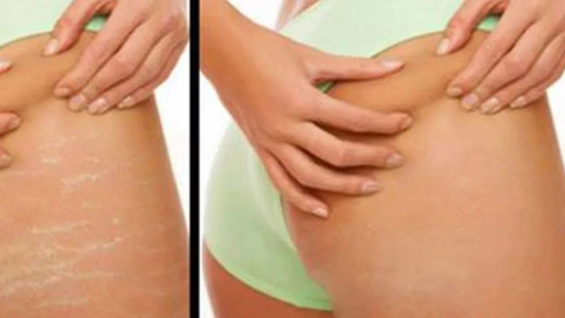 Asa scapi de vergeturi in doua saptamani cu ceva ce toata lumea are in casa! Costa 5 lei si functioneaza garantat!