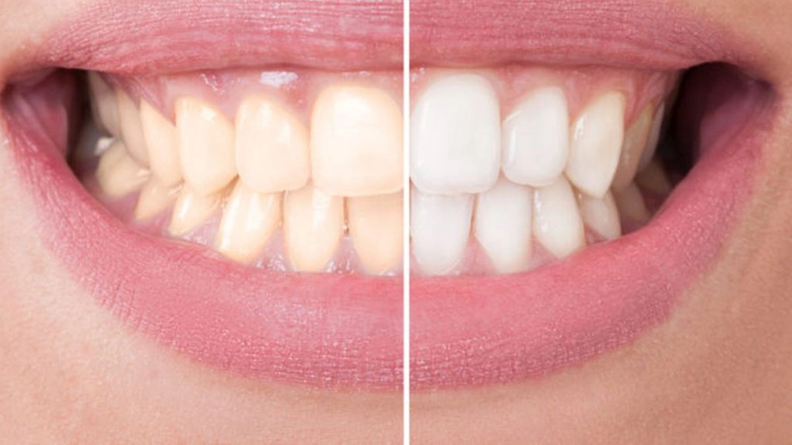 Cum să iți albești dinții acasă